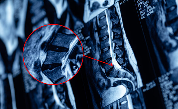 Spine mri highlighting compressed lumbar hernia disc on display