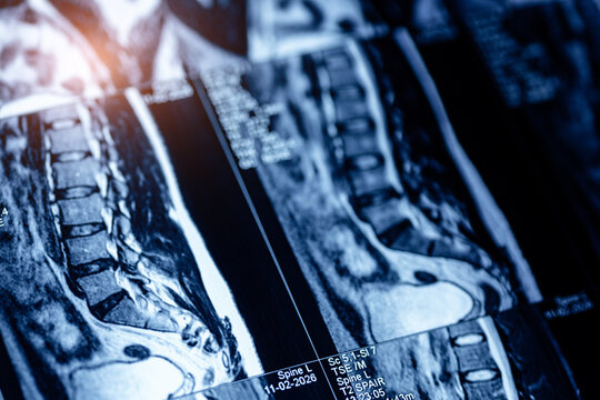 Angled mri lumbar spine sagittal images for medical diagnostic background and educational poster design, closeup macro photo
