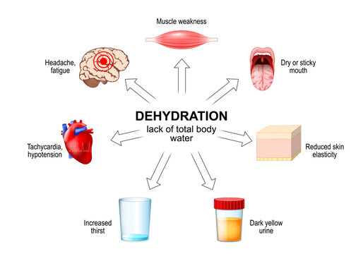 Dehydration. Signs and symptoms lack of total body water. body water deficit. clinical manifestation