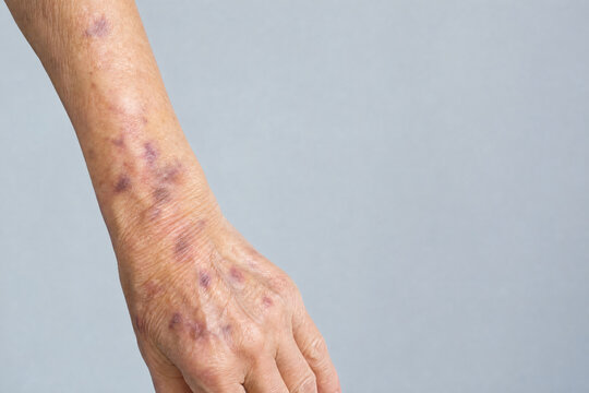 Senile Purpura on the Forearm and Back of the Hand in Older Adults