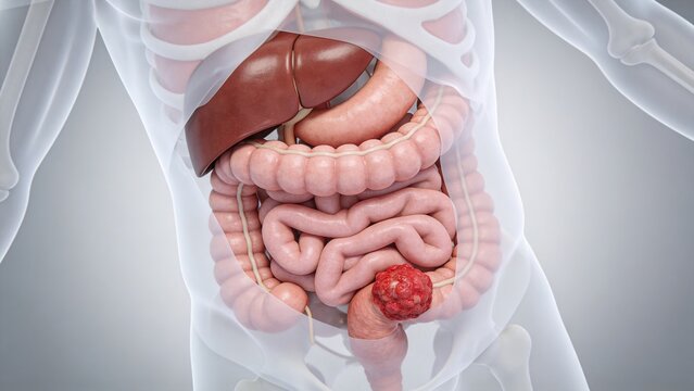 Colorectal Cancer: Malignant Tumor Lesion of Human Colon Rectum, 3D Medical Anatomical Illustration of Large Intestine