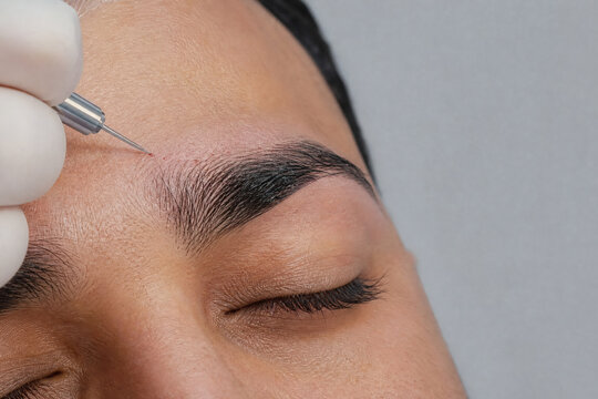 Eyebrow Transplantation in Middle Eastern Patient with Recipient Site Creation Along Natural Hair Direction