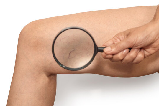 Visible vascular network  on woman's thigh through  magnifying glass. White background, isolated.