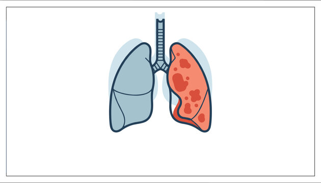 Medical illustration of human lungs highlighting pulmonary disease respiratory infection or lung cancer in bright red.