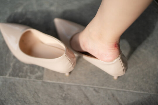 Heel blister concept showing a woman's sore red heel caused by rubbing high heel shoes, highlighting painful footwear discomfort. heel blister, sore heel, friction, high heels, foot pain
