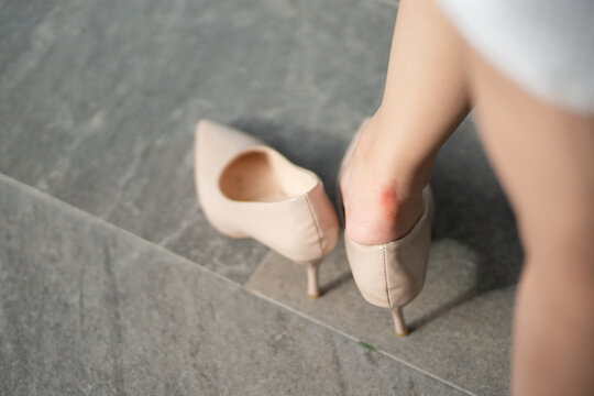 Heel blister concept showing a woman's sore red heel caused by rubbing high heel shoes, highlighting painful footwear discomfort. heel blister, sore heel, friction, high heels, foot pain
