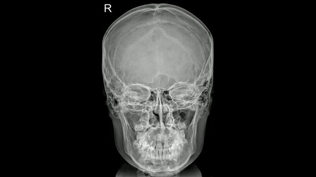 Frontal Skull X-ray Video Radiograph with Right Marker