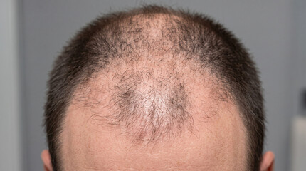 Fototapeta premium Close-Up View of Male Scalp Demonstrating Advanced Androgenetic Alopecia with Hair Thinning and Receding Hairline