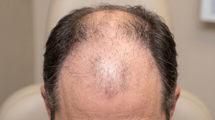 Fototapeta premium Close-Up View of Male Scalp Demonstrating Advanced Androgenetic Alopecia with Hair Thinning and Receding Hairline