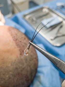 Hair Follicle Graft Held by Tweezers During Hair Restoration Surgery