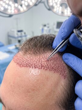 Hair Transplant Procedure Close-up with Surgeon Placing Follicle Grafts