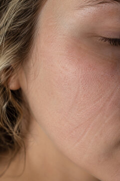 Temporary morning sleep crease on cheek close up
