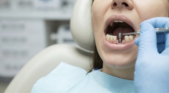 Dentist adjusting a metal impression post on a dental implant in a patient's mouth. Close up of an oral surgery procedure for tooth restoration using a hex driver tool