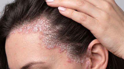 Fototapeta premium Dermatologist examining a close-up affected area beside the ear where sharply bordered inflamed patches and whitish flakes spread beneath the hair roots, plaque psoriasis, auricular involvement