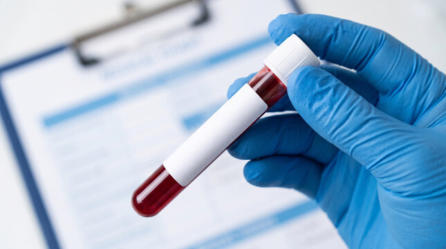 labeled blood sample test tube, medical records and blood sample, patient information and blood vial, clinical laboratory workflow