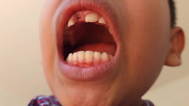 Close Up of Child Open Mouth Showing Missing Front Tooth
