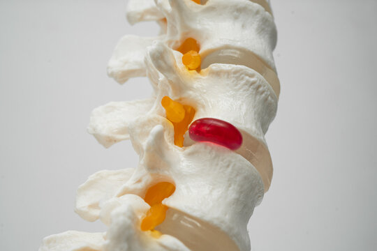 Lumbar spine displaced herniated disc fragment, spinal nerve and bone. Model for treatment medical in the orthopedic department.