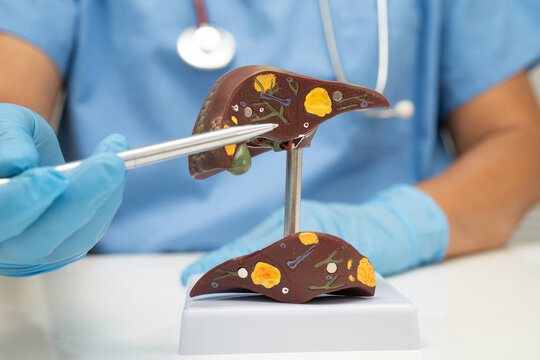 Cirrhosis, Liver cancer, fatty liver, Asian doctor with liver human model.