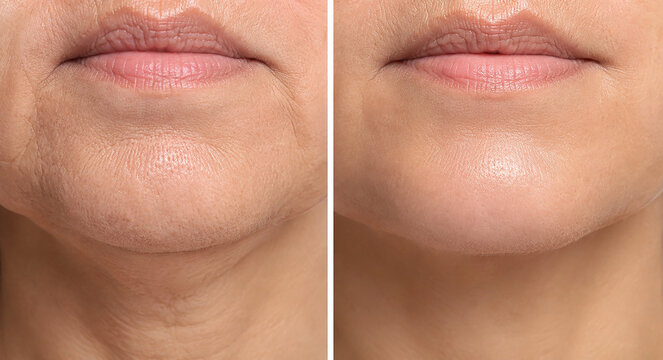 Close-up before and after skin tightening and wrinkle reduction on chin
