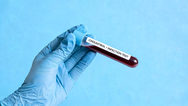 test tube with donor blood in doctor's hand on blue background. gloves hold a flask of blood for a cholesterol and infection test.medical research and development..
