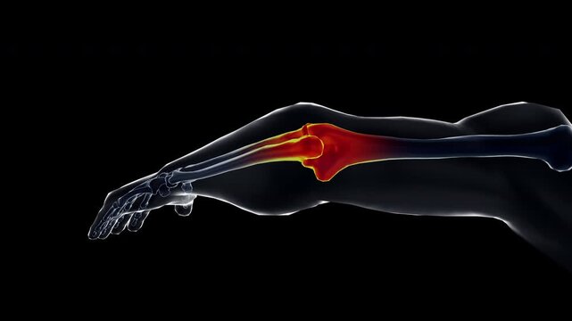 Medical dynamic video materials on bone and joint diseases