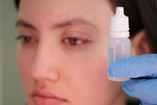 Antibacterial or antiviral eye drops on woman inflamed chalazion closeup. Eye treatment ophthalmology concept