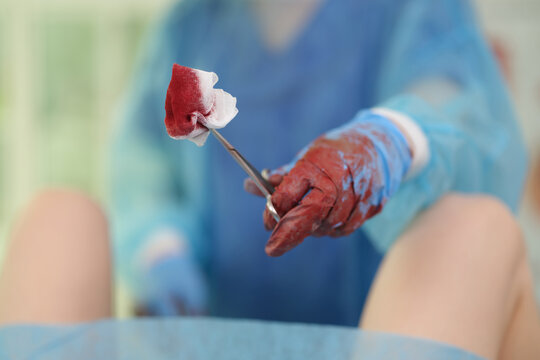 Doctor obstetrician gynecologist holding napkin with blood with clamp during surgery closeup. Surgical treatment in gynecology