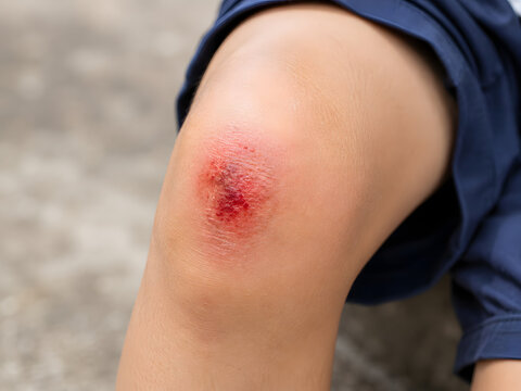 Close up of scraped knee injury with red abrasion caused by a fall