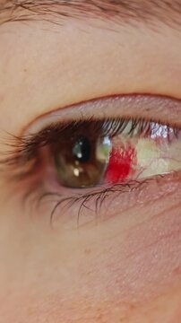Extreme close-up of a bloodshot eye with visible red veins and irritation