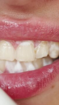 Close up of a person's mouth with toothpaste foam on teeth and lips