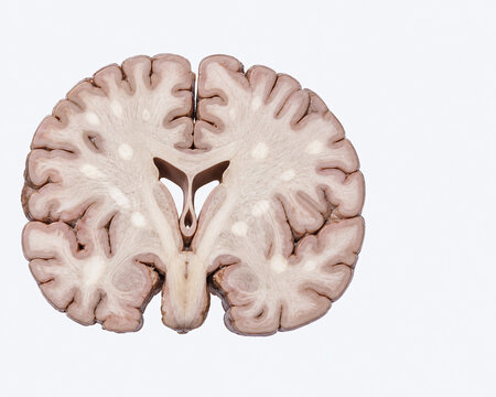 Brain slice with scattered white matter lesions