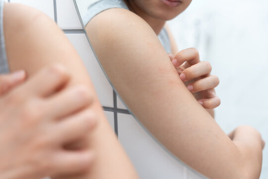 skin problem and beauty. Young woman scratch body has itchy skin from skin allergic, steroid allergy, sensitive skin, red from sunburn, chemical allergy, rash, insect bites, Seborrheic Dermatitis.