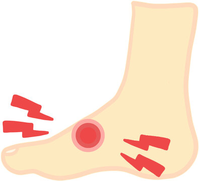 Foot instep pain, plantaritis, orthopedic foot disease, flat line illustration 
