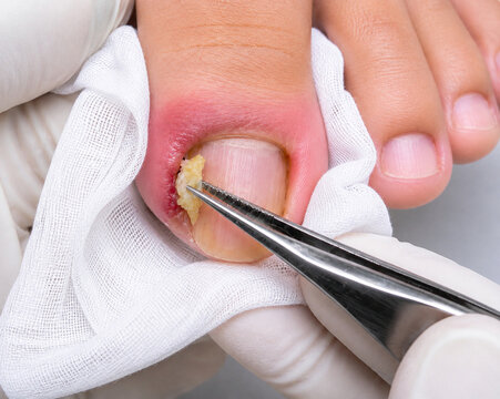 Treatment of infected ingrown toenail with surgical tweezers