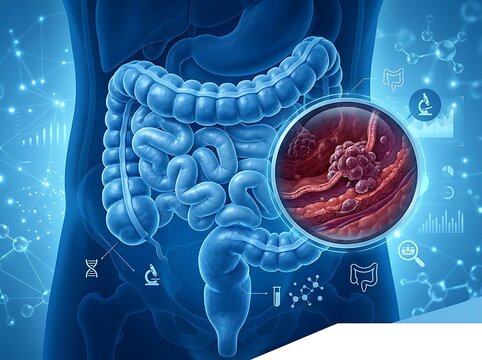 Medical illustration of the human colon with a magnified view of a tumor or polyp inside the intestinal wall, representing colorectal cancer and digestive health
