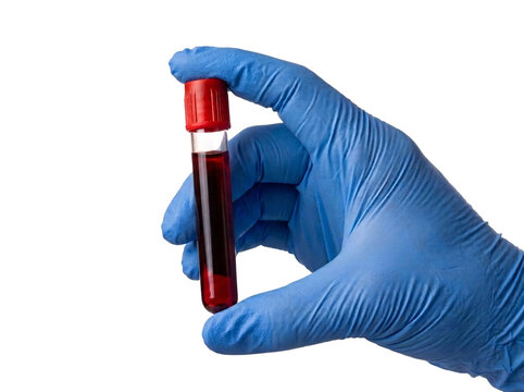 Medical blood sample tube held by gloved hand for testing.