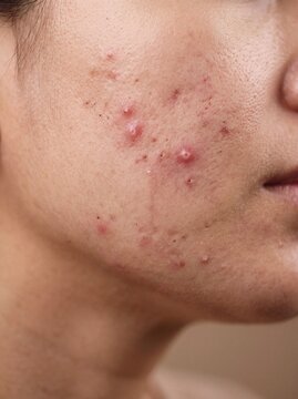 Ultra Realistic Close-Up Portrait of Female Facial Skin Showing Natural Skin Texture and Red Acne Breakouts Requiring Dermatological Care