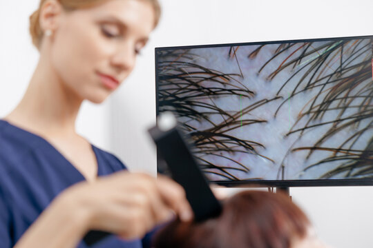 Magnified scalp display on monitor during hair clinic trichology exam with practitioner using handheld imaging tool for diagnostic consultation