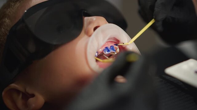 Close up of man undergoing orthodontic treatment with braces visible in his mouth. dental professional wearing black gloves uses specialized tools to adjust blue and silver brackets on teeth