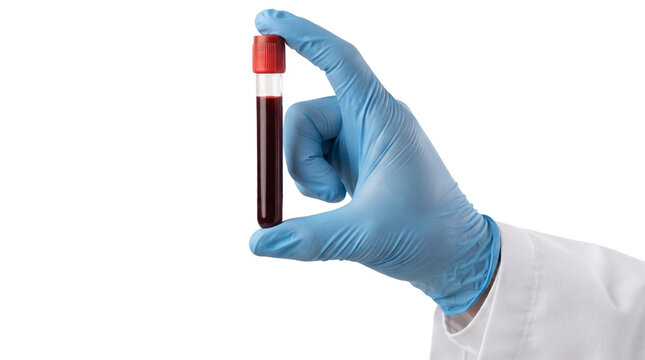 Doctor Holding Blood Sample Test Tube for Cholesterol and Infection Laboratory Testing