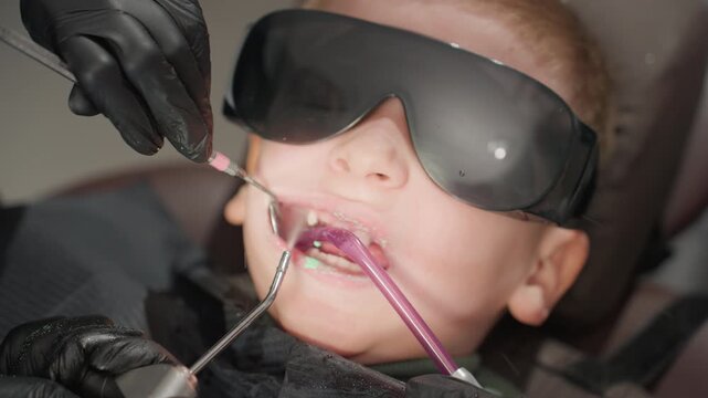 Close up of young boy receiving dental treatment with teeth whitening gel applied by orthodontist. Dental tools and protective eyewear are visible as procedure progresses in detail focusing