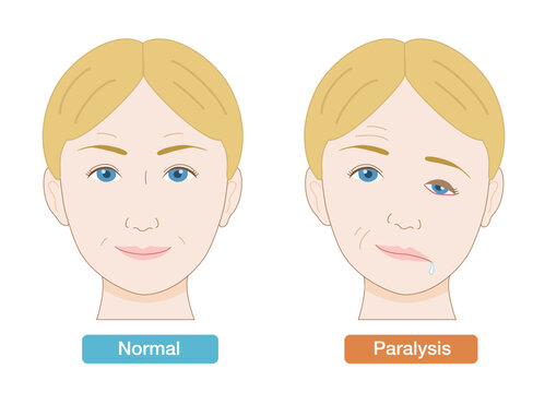 Medical Illustration Showing Facial Asymmetry and Symptoms of Facial Nerve Palsy