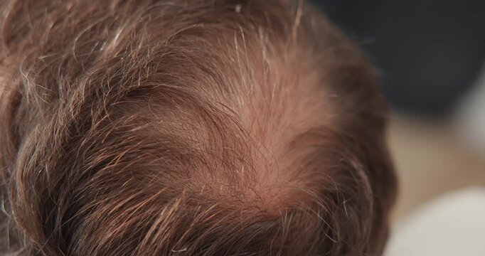 Trichologist dermatologist crown scalp inspection by clinician wearing gloves at hair clinic for male with alopecia thinning hair assessment and follicle evaluation.