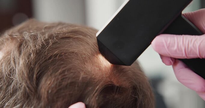 Closeup of handheld scalp scanner examining male hair for follicle analysis, concept men with alopecia.
