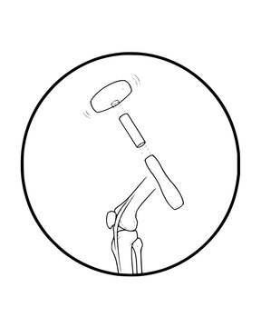 Orthopedic joint replacement implant schematic showing bone assembly in circular frame