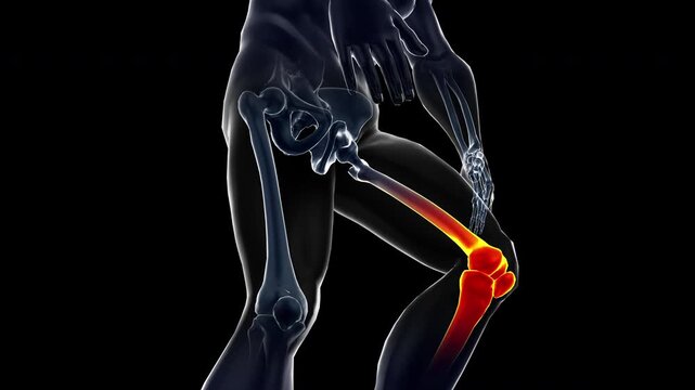 Medical dynamic video materials on bone and joint diseases