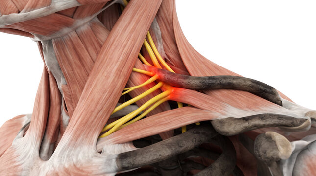 Human neck shoulder brachial plexus nerve compression pain disorder anatomical structure model isolated on white background