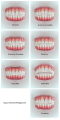 Types of Dental Misalignment © labden
