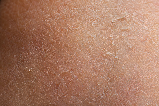 Macro close up of dry peeling human skin texture