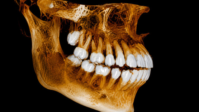 CBCT dental tomography side view of jaw teeth roots maxilla mandible anatomy for diagnostic cone beam CT dentistry scan.